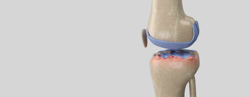 Physiotherapy Techniques for Managing Osteoarthritis