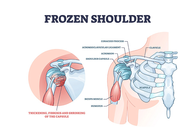 A Multidisciplinary Approach to Managing Frozen Shoulder